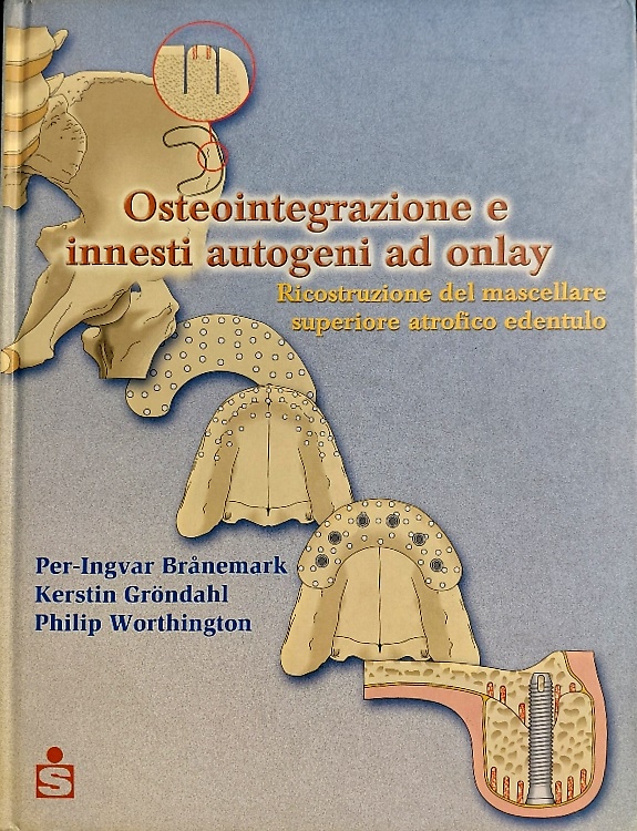 Osteointegrazione e innesti autogeni ad onlay. Ricostruzione del mascellare supe